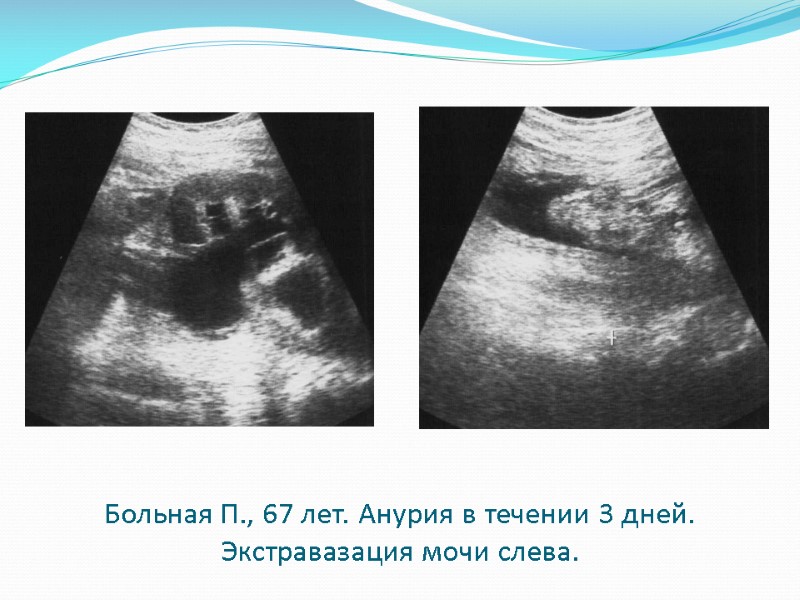 Больная П., 67 лет. Анурия в течении 3 дней. Экстравазация мочи слева.